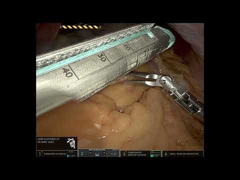 Robotic Sleeve Gastrectomy