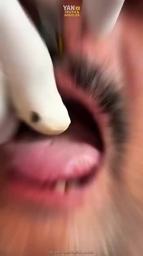 Doctors fix noses with balloons!?️😱 #medical #sinus #humanbody