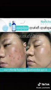 Natcha Serum  သာမာန်ထွက်တဲ့ ဝက်ခြံဖု အဆီဖု ဆင်ဝက်ခြံလို အဖု...