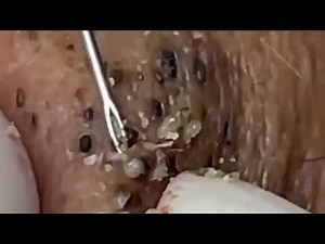 Best Comedo blackhead Extraction
