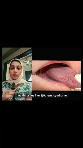 Why Your Tongue Looks Cracked 👅 | Fissured Tongue Explained