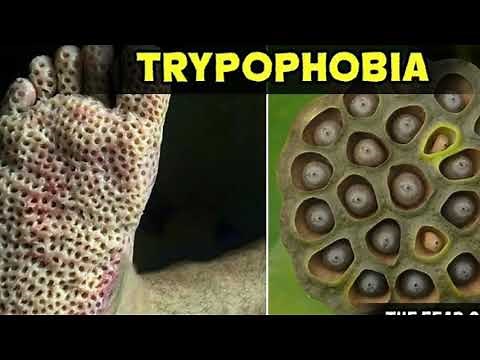 Trypophobia, what is it? Treatment. Story of Trypophobia.