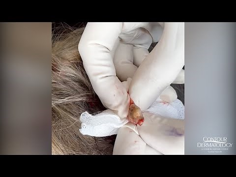 Extracting a Pilar Cyst (Pilar Cysts Can Haunt Your Scalp) | CONTOUR DERMATOLOGY