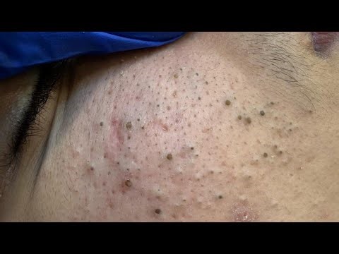 Deep Cleansing Techniques For Clear Pores — Blackhead Extraction Methods