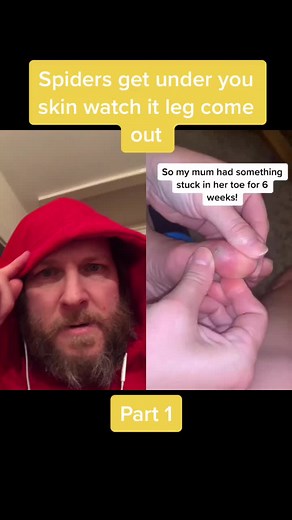 Spider Bite Infection Drainage & Skin Burrowing Insects Removal