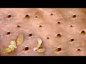 Amazing Blackheads Remover on the Face #018