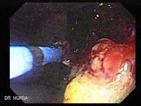 Recurrent Gastric Cancer after Gastrectomy Billroth II (5 of 6) • Video • MEDtube.net