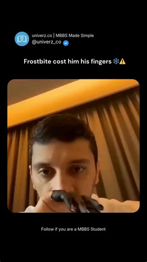 univerz.co | MBBS Made Simple on Instagram: "This is the severe consequence of advanced frostbite—tissue death leading to amputation of the fingers. Frostbite occurs when exposure to extreme cold causes: • Vasoconstriction • Ice crystal formation in tissues • Reduced blood flow • Cellular damage and necrosis If circulation is not restored in time, the affected tissue becomes non-viable, often requiring surgical removal to prevent infection and further complications. Early signs include: • Numbne