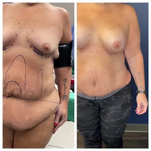 Body lift after massive weight loss. Breast/Tummy/Flank. 360 view.