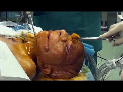 Body Bizarre : défigurée par des tumeurs