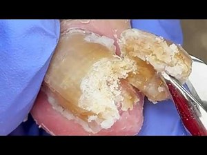 Cut Off The Huge Ingrown Toenails On Both Sides!【Podiatry Clinic】