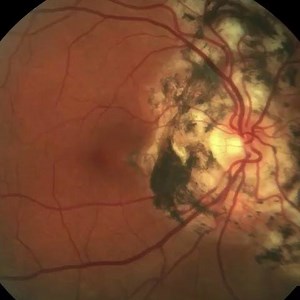 Serpiginous choroidopathy: Progression of disease over 5 years despite systemic immune suppression and intraocular steroid treatment. From 20/20 vision with a paracentral scotoma to loss of fixation with count fingers vision. The other eye had a similar course. This case demonstrates how chronic posterior uveitis can advance despite current treatments and how we need better, longer term therapies without severe side effects for these conditions. Image courtesy of [Charles Retina institute] #Jord