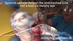Retrograde intubation