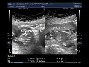 Ultrasound Video showing Anencephaly with Pregnancy of about 16 weeks 04 days.
