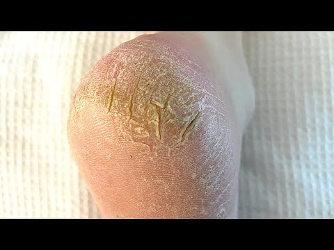Severely Cracked Callused And Painful Heel Is Treated | Satisfying Skin Removal