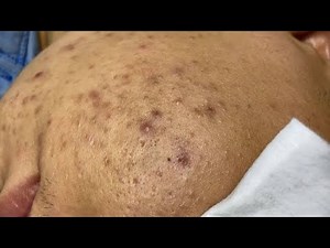 ASMR deep cleansing asmr | acne & blackhead removal#asmr