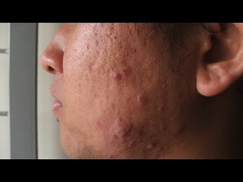 What Is Cystic Acne? | Acne Treatment