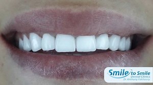 Professionally treated to give you a natural Hollywood Smile! To book your appointment, contact us on:  +961 71 174 746 | Smile To Smile Dental Clinics | Facebook