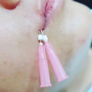 #liplyft #thread are inserted through the borders of the lips and “when inserted beneath the skin, the PDO sutures hold up drooping skin like a scaffold. The results are subtle: “You will notice more of a definition than volume increase. The outline of your lips is likely to be more raised and therefore more defined. Think of it as a semi-permanent lip liner with an extra bit of lift.” aurishartmedic #Drsehrish #DrAun #AestheticsPhysician #Cosmetologist #MedicalAesthetician #PMUspecialist # #BHR