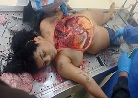 Venezuelan model autopsy.