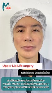 Bullhorn lip lift (Upper lip lift surgery) เคสคุณผู้ชาย หลังทำทันที การผ่าตัดยกริมฝีปากบน ช่วยปรับสัดส่วนใบหน้าให้สวยงาม ดูเด็กลง เปิดริมฝีปากให้อวบอิ่ม ได้ทรงสวย เทคนิคซ่อนไหมแผลเนียนกริบ ดูแลแผลง่ายย สวยฟินๆ ได้ที่นี่ Millet clinic, Cosmetic surgery, Dr.Kook ตาสองชั้น เสริมจมูก,คาง ปากกระจับ by dr kook แพทย์หญิงประภัสรา กิตติธณิกนันท์ #ผ่าตัดยกริมฝีปากบน #Upperlipliftsurgery #subnasalliplift #Bullhornliplift #หมอกุ๊ก #มือวางเบอร์ต้นวงการศัลย์ #เนี๊ยบตัวแม่ #แผลสวยกริบ #Milletclinic #มิลเลทคลิน