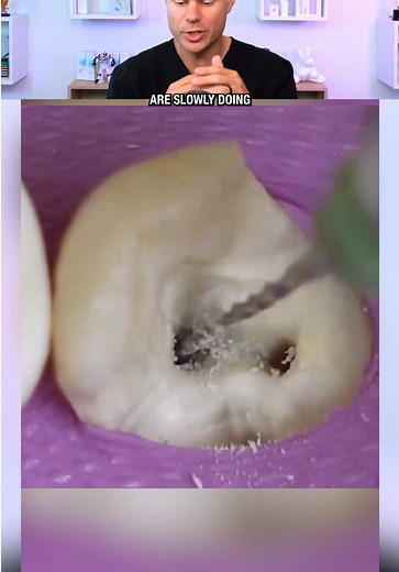 Dentist Reveals What REALLY Happens In A Root Canal! 😳🦷 #teeth #dentist #mouth