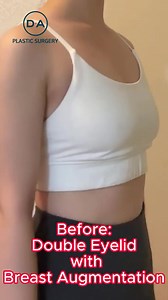 Amazing DA Results!✨ Enhance Your Beauty and Be More Confident!💕 Find your inner beauty and outer beauty with DA 💖 Visit DA Plastic Surgery & Dermatology🥰 For more information, DM us or contact 📞 WhatsApp: 010-3455-7111 📱 KakaoTalk: DAPRSEN #plasticsurgery #daplasticsurgery #plasticsurgerykorea #plasticsurgeryformen #plasticsurgeryforwomen #beautifuleyes #beautifulnose #rhinoplasty #rhinoplastykorea #eyesurgerykorea #canthoplasty #vlinesurgery #facialcontouring #cheekbonereduction #vlinesur