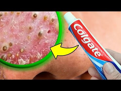 Como Tirar CRAVOS e ESPINHAS em 10 MINUTOS sem GASTAR Nada