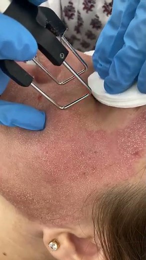 Tratament laser CO2 față⚡️Scăpă de cicatrici, riduri, pete pigmentare, vergeturi💚Clinicile SKiN