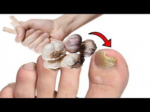 How To Get Rid of Nail Fungus Using Garlic