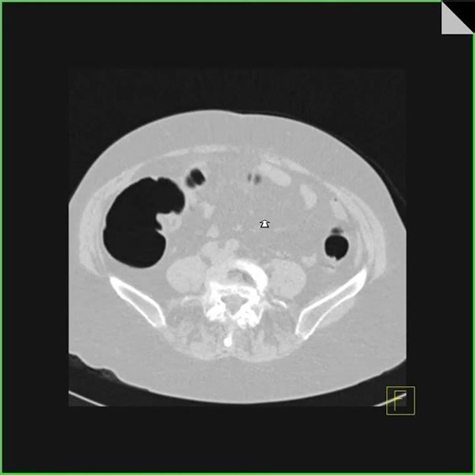 Virtual colonoscopy with cancer in transverse colon 2