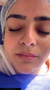 Derma pen mesotherapy ♥️ | Hagar Tarek Makeup Artist