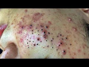 Blackhead Removal With Sac Dep Spa @668