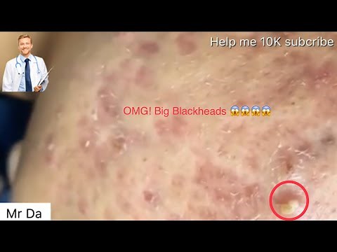 Big Blackheads removal new video 2020-2021