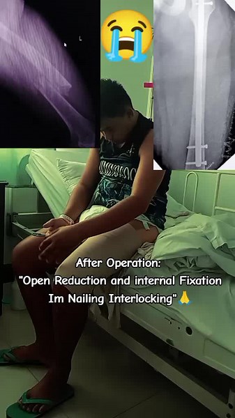 Closed Femur Fracture Recovery Journey