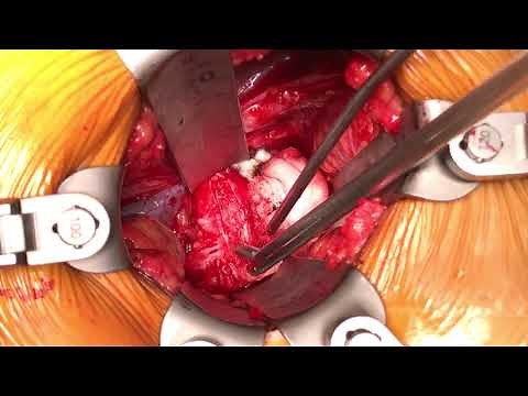 L5/S1 Anterior Lumbar Interbody Fusion (ALIF)