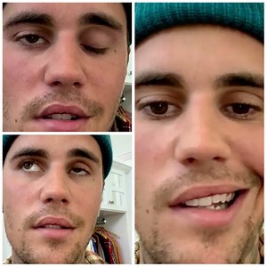 What's Ramsay Hunt Syndrome? Justin Bieber Reveals Neurological Disorder Gave Him Facial Paralysis (VIDEO)