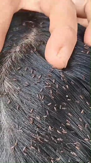 13K views · 18 reactions | Remove thousand lice from head | Jackie Chan Fan | Facebook