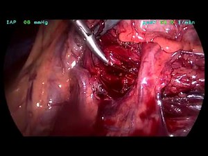 How to do a laparoscopic pyeloplasty for pelviureteric obstruction