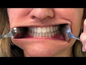 How To Take Pictures For Your Invisalign Virtual Appointment (Bee Cave Orthodontics)