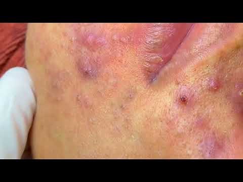sac dep spa acne treatment and removal blackheads #5002