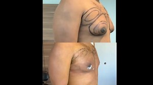 gynecomastia treatment by bodytite #bodytite #inmode | MDF GROUP
