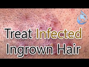 How to Treat Infected Ingrown Hair