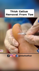 20K views · 43 reactions | Thick Callus Removal From Toe and Corn On bottom of Foot Full Treatment By Miss Foot Fixer | Miss Foot Fixer | Facebook