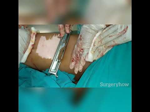 split-thickness skin graft technique