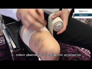 Above knee amputation AKA wrapping