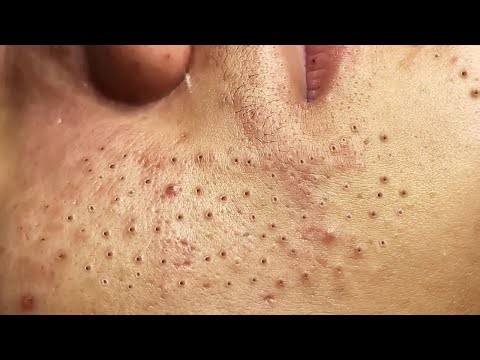 Blackhead removal Video #119 #Blackheads #blackheadsremoval #blackheadsextraction