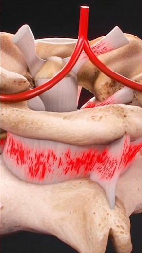 Spine Ligament Injury Explained | How It Affects Your Nerves!
