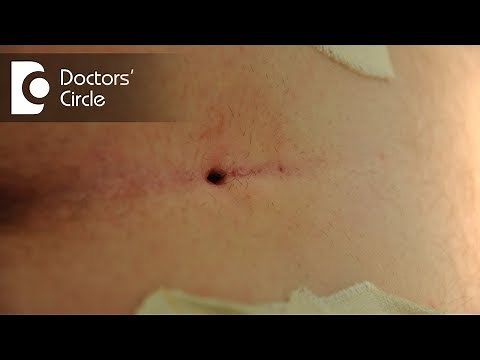 What can cause tailbone abcess and its management? - Dr. Ajay Rao