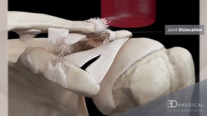 Take a look at what happens to the connective tissue in an AC (acromioclavicular) Joint dislocation (Grade 3) with help from the 3D4Medical models. | Complete Anatomy